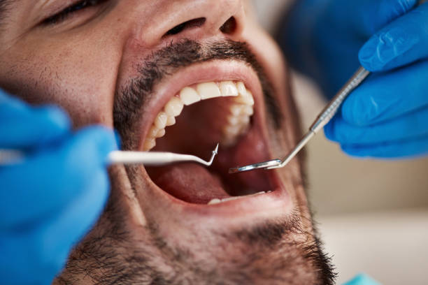 Best Chipped Tooth Repair Near Me  in Mountain Lake Park, MD